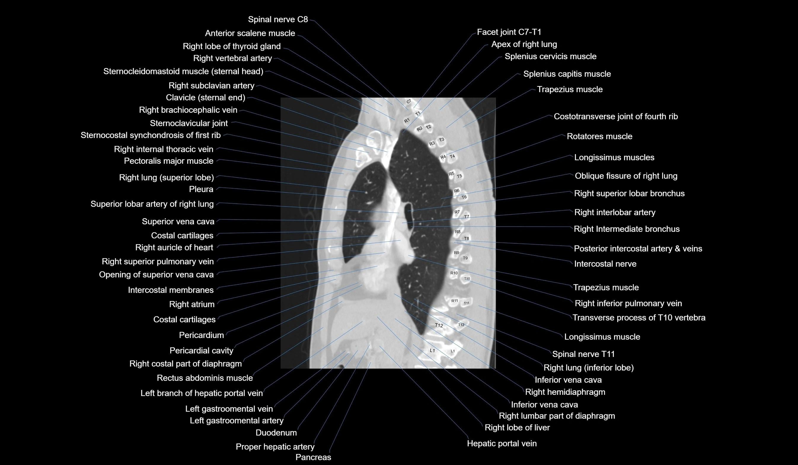 CT chest (thorax) lung window labelled sagittal cross sectional anatomy radiology image-00064.webp